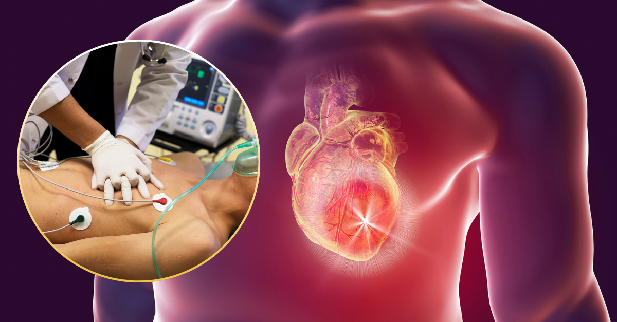 Cardiac Arrest ICD coding